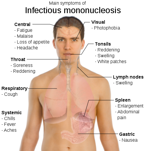 Symptoms of Mono Rash: Infectious Mononucleosis Causes, Treatment